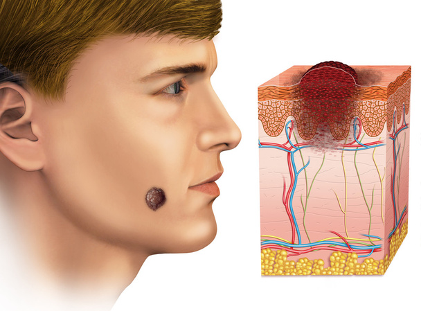 Melanoma en la cara
 - Foto, Imagen