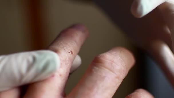 Doctor in gloves examines the hands of a man with psoriasis. - Video