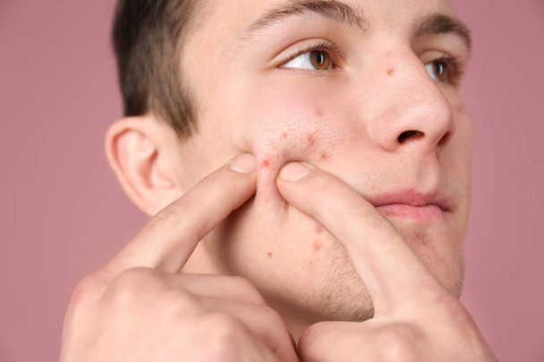 Young man squeezing acne on color background - Foto, Bild
