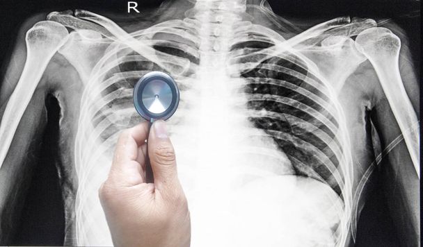 Orvos keze gazdaság sztetoszkóp, és mutat a beteg mellkasi röntgen film kezelés előtt. Kép a tüdő a radiológiai osztályon a kórházi. - Fotó, kép