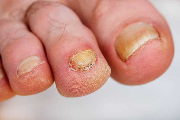 Misvormde nagelplaat van de teen, besmet met een nagel schimmel. - Foto, afbeelding