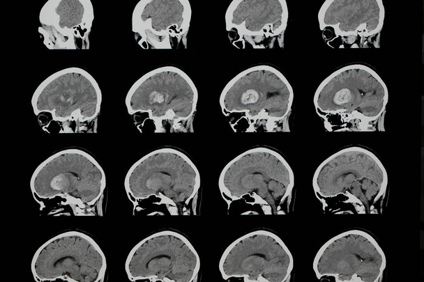 tomodensitométrie cérébrale (TDM) d'un patient présentant une hémorragie intracrânienne importante (AVC hémorragique) dans son hémisphère cérébral gauche
 - Photo, image