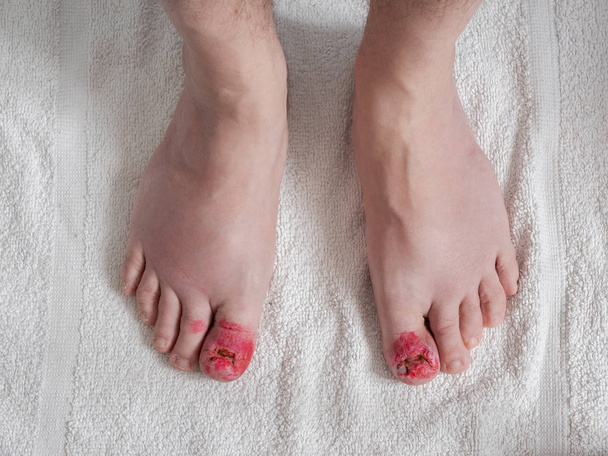 Dedos dos pés após cirurgia às unhas encravadas. Aparência convalescente sem unhas com pontos, vermelho desinfetante e cura
. - Foto, Imagem