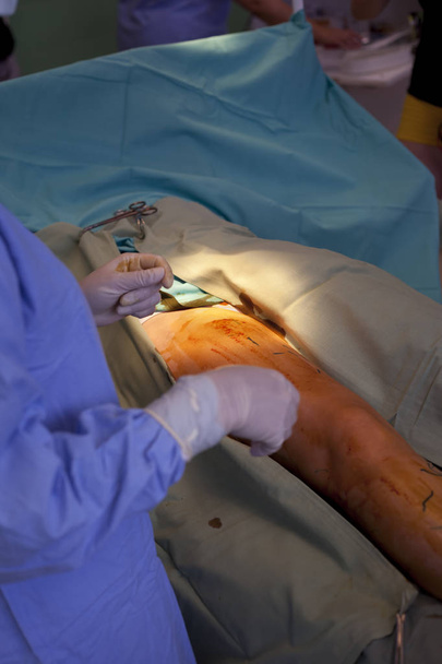 Operation von Krampfadern im Operationssaal - Foto, Bild