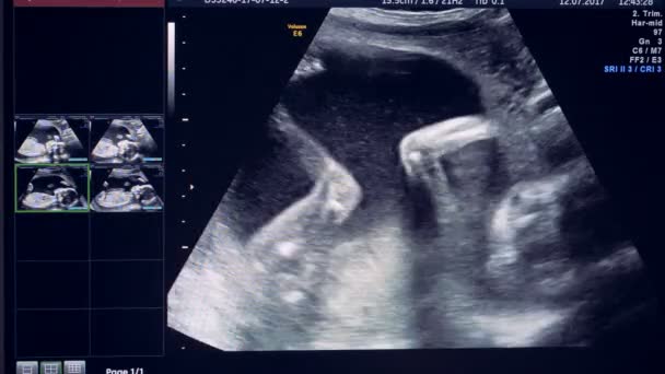 Embrión está moviendo activamente un balanceo sobre una imagen de ultrasonido
 - Imágenes, Vídeo