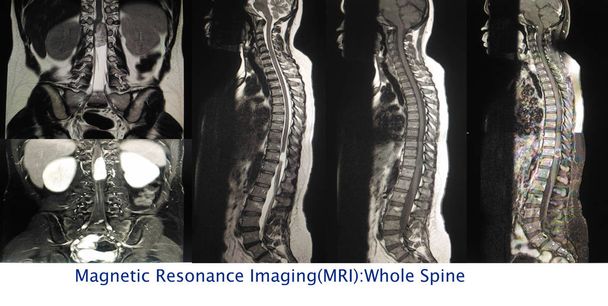 Primer plano Resonancia magnética Espina dorsal completa Un ser humano Muestra múltiples imágenes masa extramedular intradural a nivel Lt lateral a la médula espinal a nivel T11 y causa compresión de la cordón umbilical.
. - Foto, Imagen