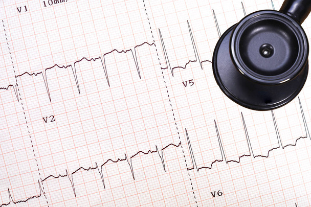 異常な心電図トレース(横壁虚血)と黒聴診器、心臓病の概念、医学的背景、医学教育 - 写真・画像