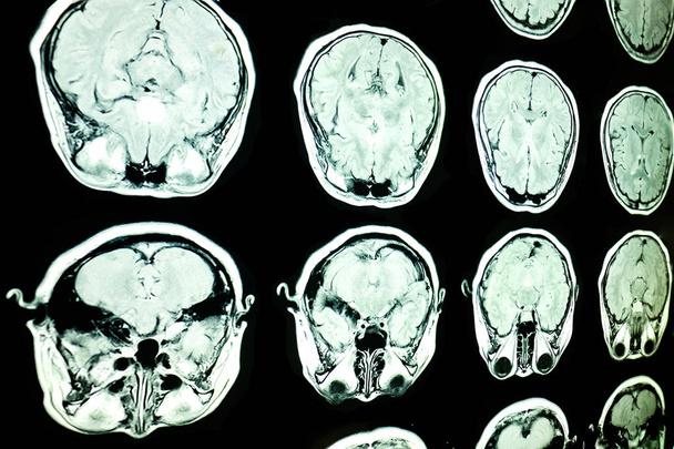 磁気共鳴画像脳のMRIスキャン - 写真・画像