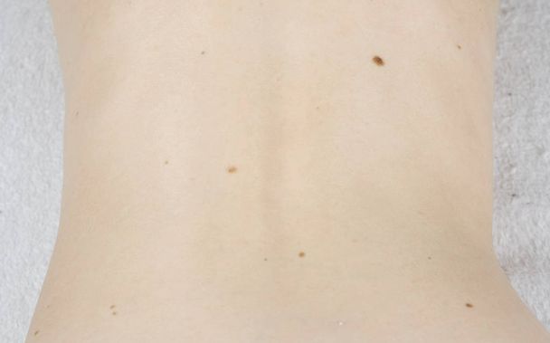 Womans white skin in back with moles. View top. Camera movement from the bottom up. - Fotoğraf, Görsel