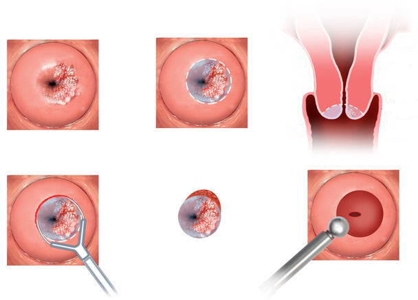 Tumor cervical
 - Foto, Imagen