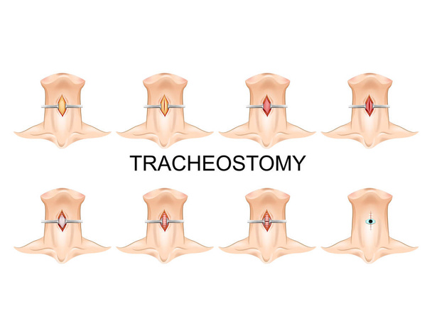 tracheostomybuis. chirurgie - Vector, afbeelding