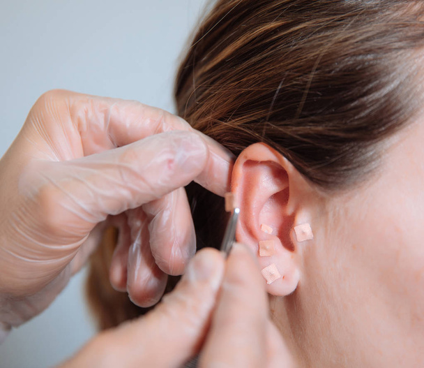 doctor putting acupuncture needles in the ear - Fotó, kép