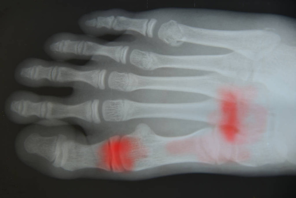 bone of foot x-ray film. - Photo, Image