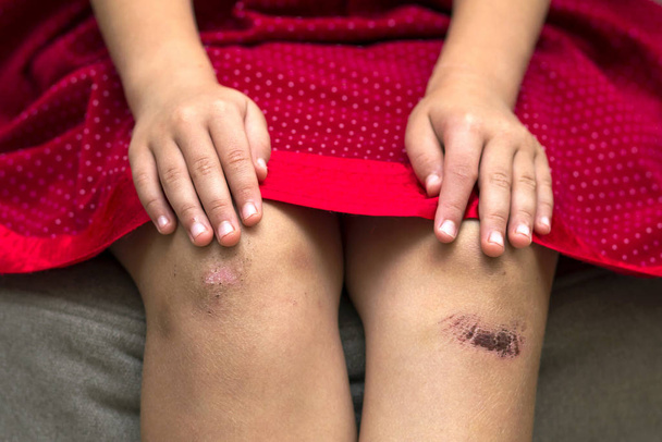 Κοντινό πλάνο του κοριτσάκι που κρατάει το μελανιασμένο τραυματισμένο γόνατο είναι κατεστραμμένο - Φωτογραφία, εικόνα