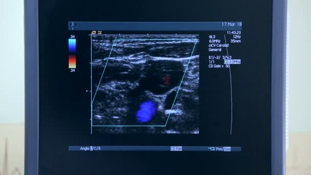 Ultrazvukový přístroj s monitorem. Vyšetření srdce - Záběry, video