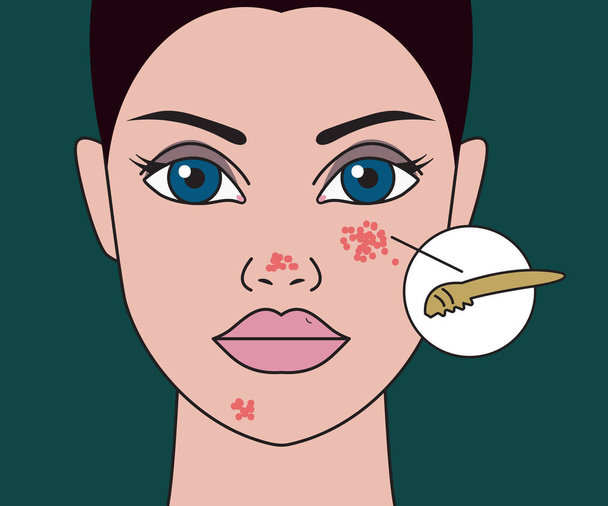 pimples on skin - Vector, Image