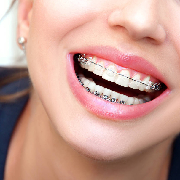 Feche a boca aberta com aparelhos cerâmicos e metálicos em belos dentes - Foto, Imagem