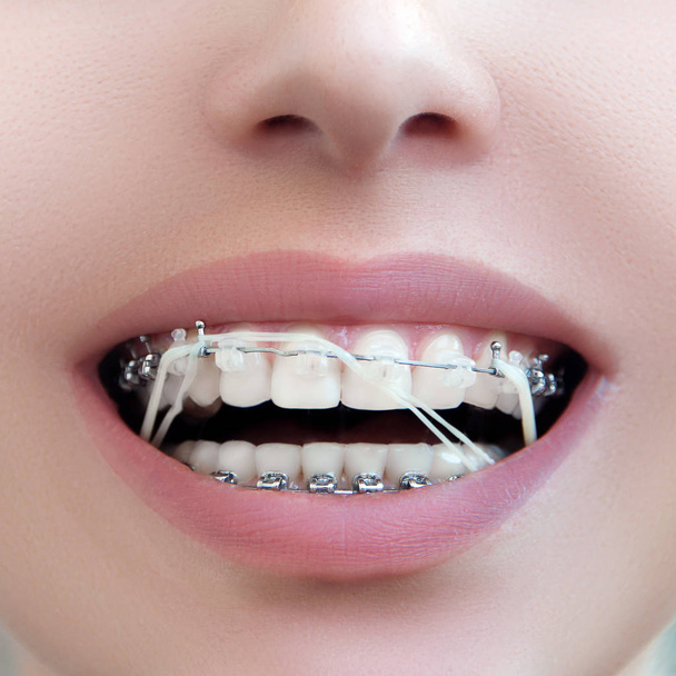 Zbliżenie Uchwyty dentystyczne z gumową elastyczną opaską. Otwórz kobiece usta z samouwiązującymi się aparatami. Leczenie ortodontyczne. - Zdjęcie, obraz