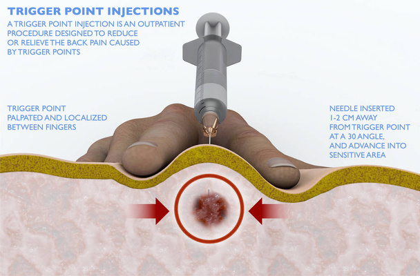 Een trigger-punt-injectie is een poliklinische procedure ontworpen te verminderen of te verlichten van de pijn in de rug veroorzaakt door triggerpoints. Intramusculaire injectie, punctie onder huid met spuit. Rugpijn. 3D-rendering - Foto, afbeelding