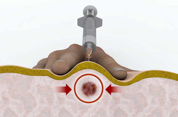 A trigger pont injekció a járóbeteg-eljárás célja, hogy csökkentse, vagy enyhíti a hátfájást, trigger pontok okozta. Intramuscularis injekció, injekciós tűvel a bőr alá szúrt. Hátfájás. 3D-leképezés - Fotó, kép