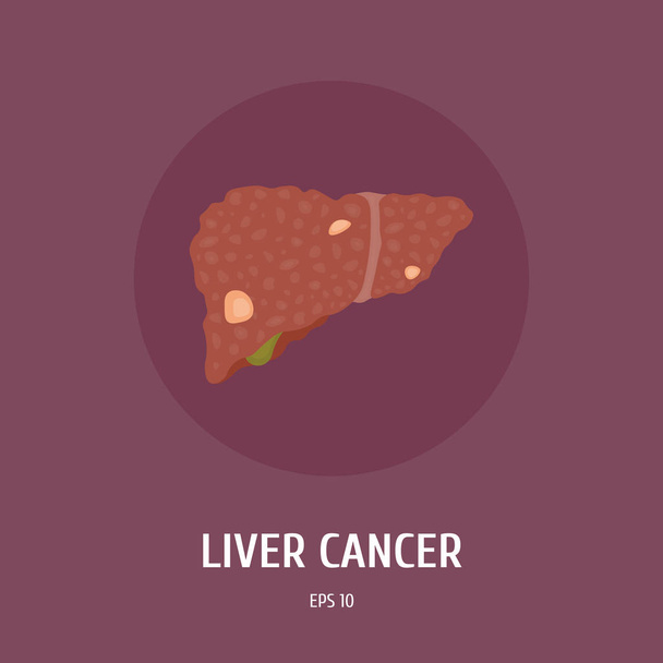Karaciğer kanseri. Adam iç organların. Ameliyat. Vektör düz çizim - Vektör, Görsel