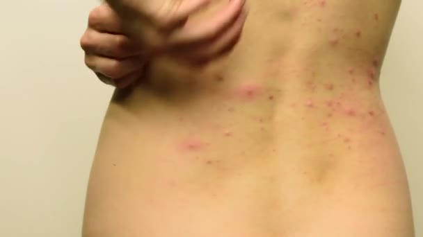 De achterkant van een tienermeisje met rode en witte acne die zij krassen en uitstrijkjes met room - Video