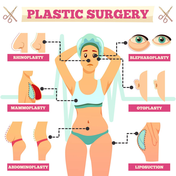 Chirurgia plastyczna ortogonalnych schemat blokowy - Wektor, obraz