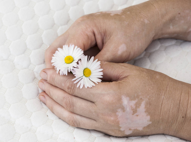 eine Hand mit Vitiligo Hautzustand - Foto, Bild