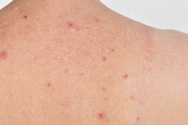 dermatite nas costas de uma mulher
 - Foto, Imagem