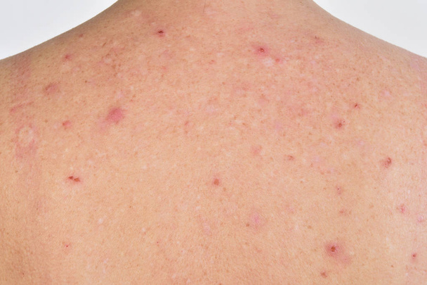 a hátán egy nő dermatitis - Fotó, kép