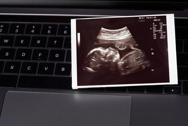 Imagen de ultrasonido del bebé
 - Foto, imagen