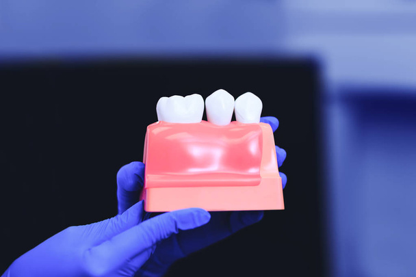 Zahnimplantate und Zahn in den Händen eines echten Arztes. Zahnkrone, Implantate und Zähne nach Zahnmodell, am besten für zahnmedizinische Konzeptprojekte. schöne gesunde Zähne für Zahnimplantat-Konzept. Kieferorthopädische Behandlung mit Zahnimplantaten.  - Foto, Bild