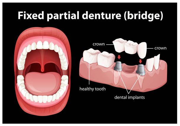 Lékařské vektor pevné Částečná zubní protéza - Vektor, obrázek