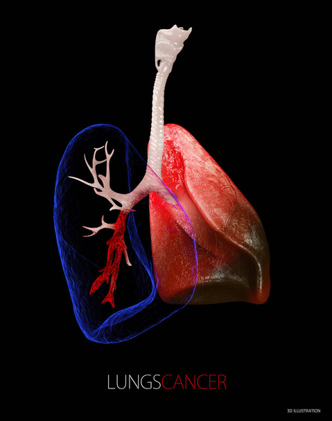 Lung cancer, pleural effusion 3d Illustration isolated black - Photo, Image