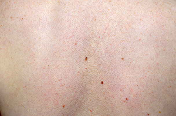 Pecho de la piel de la persona con lunares y pecas
 - Foto, imagen