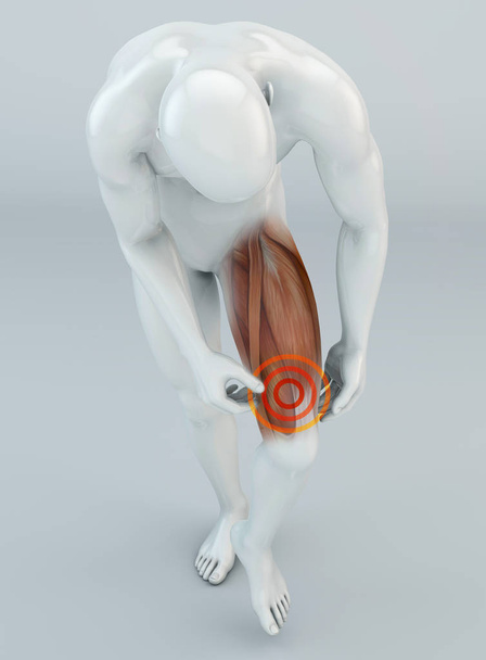 Spier scheuren, bovenbeenspieren boven de knie. Pijn in het been en ligamenten. Menselijk lichaam, 3D-rendering - Foto, afbeelding