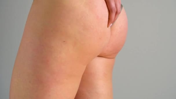 Vrouwelijke hip striae en cellulitis op de huid - Video
