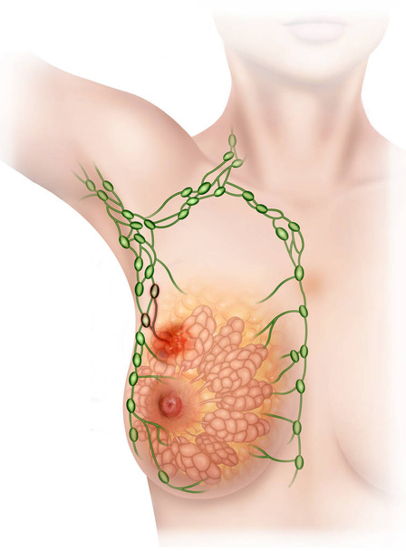 Breast cancer detected in the lymphatic system - Photo, Image