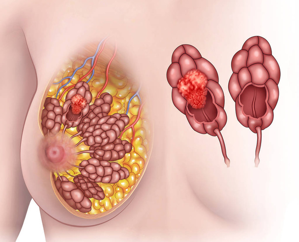 Descriptive illustration of breast lobule cancer. - Photo, Image