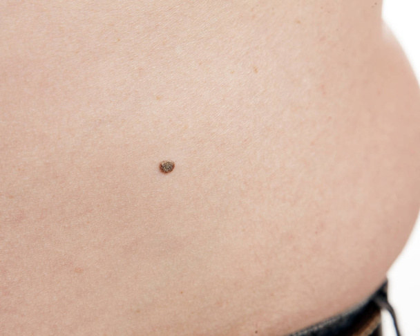 Skin cancer in men. - Photo, Image