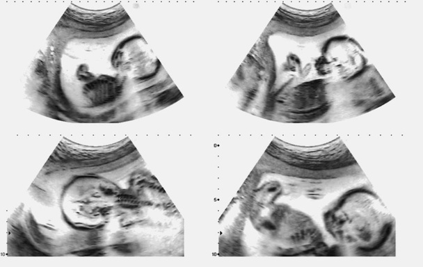 Collage di immagini mediche di ultrasuoni durante la gravidanza della donna che mostrano il feto nel terzo mese
. - Foto, immagini