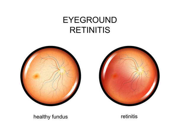 eye, fundus. retinitis - Vector, Image