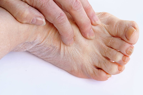 Μια ηλικιωμένη γυναίκα έχει φαγούρα και το ξηρό δέρμα, τα χέρια και τα πόδια - Φωτογραφία, εικόνα