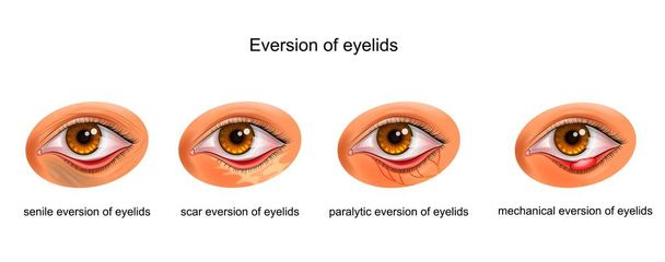 de oorzaken van eversie van oogleden - Vector, afbeelding