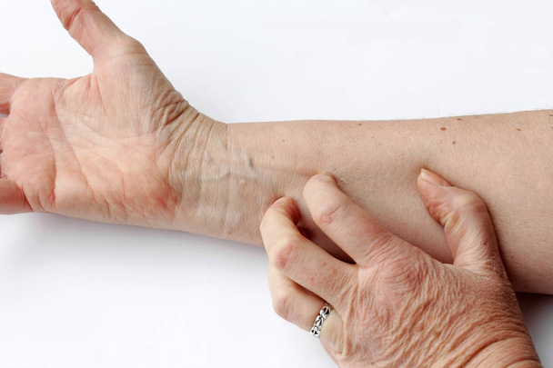Egy nő van a száraz viszkető bőr belső oldalán a karját - Fotó, kép