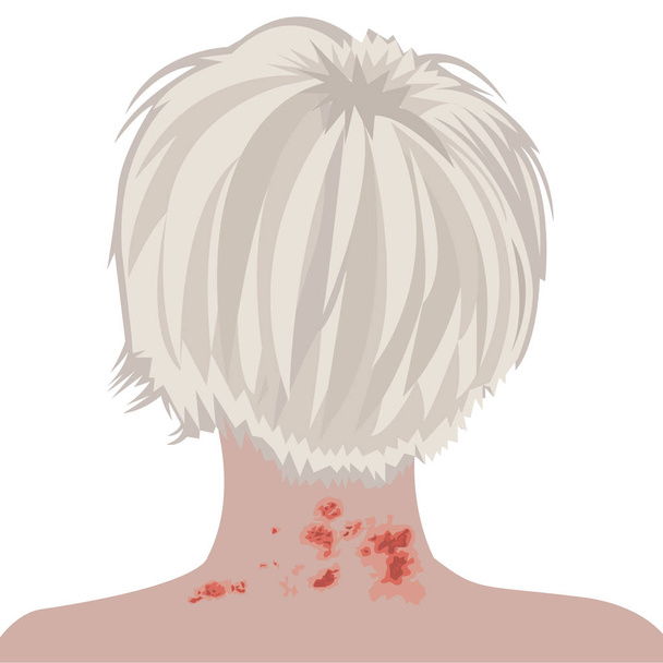 Shingles on a woman neck vector illustration - Vector, Image