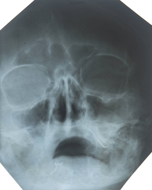 X-ray of the sinuses of the nose - Photo, Image