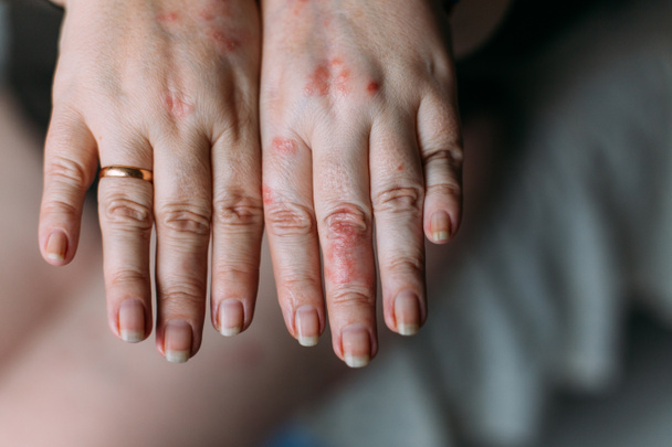 The problem with many people - eczema on hand. Womans hands - Photo, Image