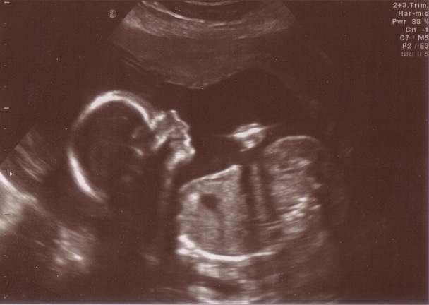 Scan Image of Unborn Child in Womb - Photo, Image