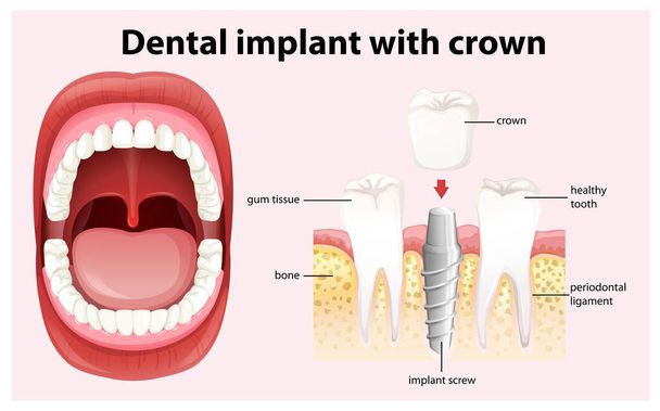 Dental Implant with Crown Vector - Vector, Image